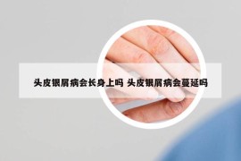 頭皮銀屑病會(huì)長身上嗎 頭皮銀屑病會(huì)蔓延嗎
