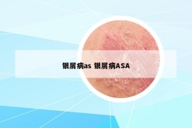 銀屑病as 銀屑病ASA