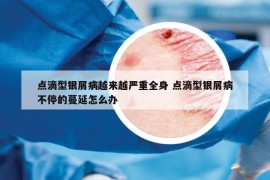 點滴型銀屑病越來越嚴重全身 點滴型銀屑病不停的蔓延怎么辦