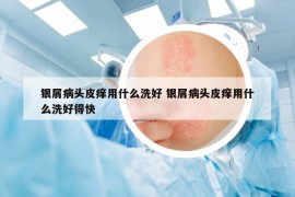 銀屑病頭皮癢用什么洗好 銀屑病頭皮癢用什么洗好得快