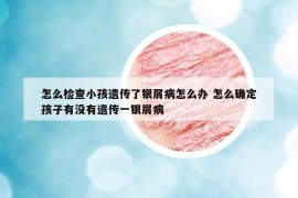 怎么檢查小孩遺傳了銀屑病怎么辦 怎么確定孩子有沒(méi)有遺傳一銀屑病