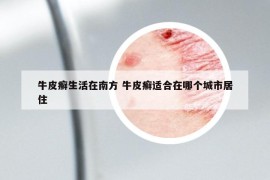 牛皮癬生活在南方 牛皮癬適合在哪個(gè)城市居住