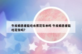 牛皮癬患者能吃水煮花生米嗎 牛皮癬患者能吃花生嗎?