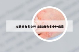 皮膚癬有多少種 皮膚癬有多少種病毒