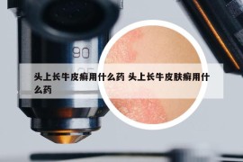 頭上長牛皮癬用什么藥 頭上長牛皮膚癬用什么藥