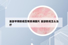 面部早期膿皰型銀屑病圖片 面部膿瘡怎么治療