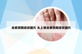 皮癬初期癥狀圖片 頭上銀皮癬初期癥狀圖片