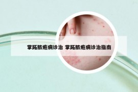 掌跖膿皰病診治 掌跖膿皰病診治指南