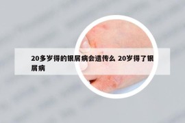20多歲得的銀屑病會(huì)遺傳么 20歲得了銀屑病