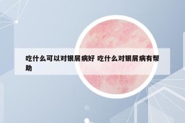 吃什么可以對(duì)銀屑病好 吃什么對(duì)銀屑病有幫助