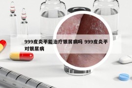999皮炎平能治療銀屑病嗎 999皮炎平對銀屑病