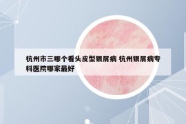 杭州市三哪個看頭皮型銀屑病 杭州銀屑病?？漆t(yī)院哪家最好