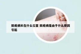 膿皰病長在什么位置 膿皰病是由于什么原因引起
