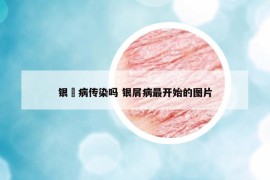 銀痟病傳染嗎 銀屑病最開始的圖片