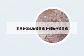 家用針怎么治銀屑病 針劑治療銀屑病