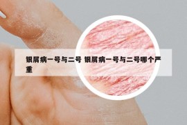 銀屑病一號(hào)與二號(hào) 銀屑病一號(hào)與二號(hào)哪個(gè)嚴(yán)重