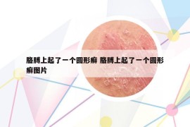 胳膊上起了一個圓形癬 胳膊上起了一個圓形癬圖片