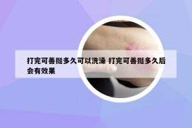 打完可善挺多久可以洗澡 打完可善挺多久后會(huì)有效果