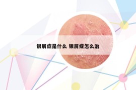 銀屑癥是什么 銀屑癥怎么治