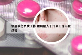 銀屑病怎么找工作 銀屑病人干什么工作不被歧視