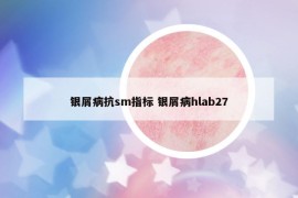 銀屑病抗sm指標 銀屑病hlab27