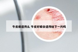 牛皮癬遺傳么 牛皮好癬會遺傳給下一代嗎