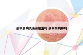 副銀屑病洗澡會加重嗎 副銀屑病癢嗎