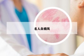 名人白癜風(fēng)