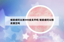 銀屑病可以用999皮炎平嗎 銀屑病可以擦皮康王嗎