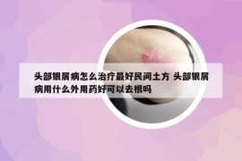 頭部銀屑病怎么治療最好民間土方 頭部銀屑病用什么外用藥好可以去根嗎