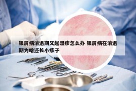 銀屑病消退期又起濕疹怎么辦 銀屑病在消退期為啥還長小疹子
