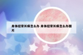 身體經常長癬怎么辦 身體經常長癬怎么辦圖片