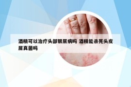 酒精可以治療頭部銀屑病嗎 酒精能殺死頭皮屑真菌嗎