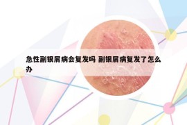 急性副銀屑病會(huì)復(fù)發(fā)嗎 副銀屑病復(fù)發(fā)了怎么辦