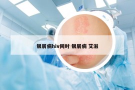 銀屑病hiv同時(shí) 銀屑病 艾滋