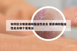 如何區(qū)分銀屑病和脂溢性皮炎 銀屑病和脂溢性皮炎哪個(gè)更難治