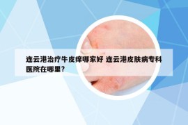連云港治療牛皮癢哪家好 連云港皮膚病?？漆t(yī)院在哪里?