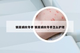 銀屑病秋冬季 銀屑病秋冬季怎么護(hù)理