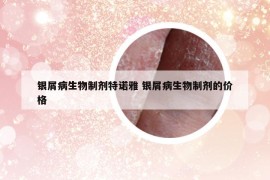 銀屑病生物制劑特諾雅 銀屑病生物制劑的價格