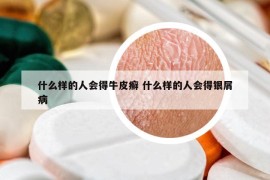 什么樣的人會得牛皮癬 什么樣的人會得銀屑病