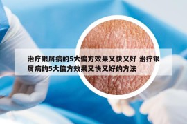 治療銀屑病的5大偏方效果又快又好 治療銀屑病的5大偏方效果又快又好的方法