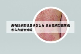 患有膿皰型銀屑病怎么辦 患有膿皰型銀屑病怎么辦能治好嗎