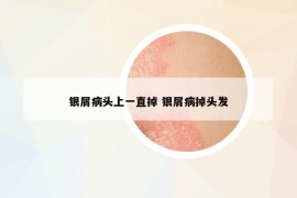 銀屑病頭上一直掉 銀屑病掉頭發(fā)