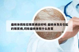 扁桃體摘除后銀屑病會好嗎 扁桃體發(fā)炎引起的銀屑病,切除扁桃體有什么危害