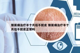 銀屑病治療半個(gè)月后不脫皮 銀屑病治療半個(gè)月后不脫皮正常嗎