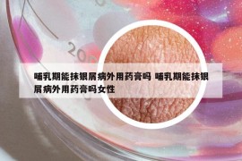 哺乳期能抹銀屑病外用藥膏嗎 哺乳期能抹銀屑病外用藥膏嗎女性