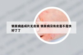銀屑病連成片無皮屑 銀屑病沒有皮是不是快好了了