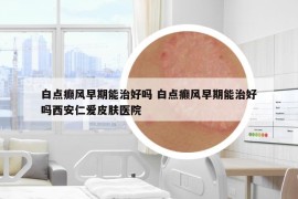 白點(diǎn)癲風(fēng)早期能治好嗎 白點(diǎn)癲風(fēng)早期能治好嗎西安仁愛皮膚醫(yī)院