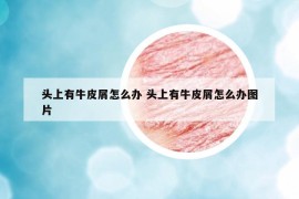 頭上有牛皮屑怎么辦 頭上有牛皮屑怎么辦圖片