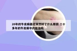 20年的牛皮癬最近突然好了什么原因 二十多年的牛皮癬中藥能治嗎